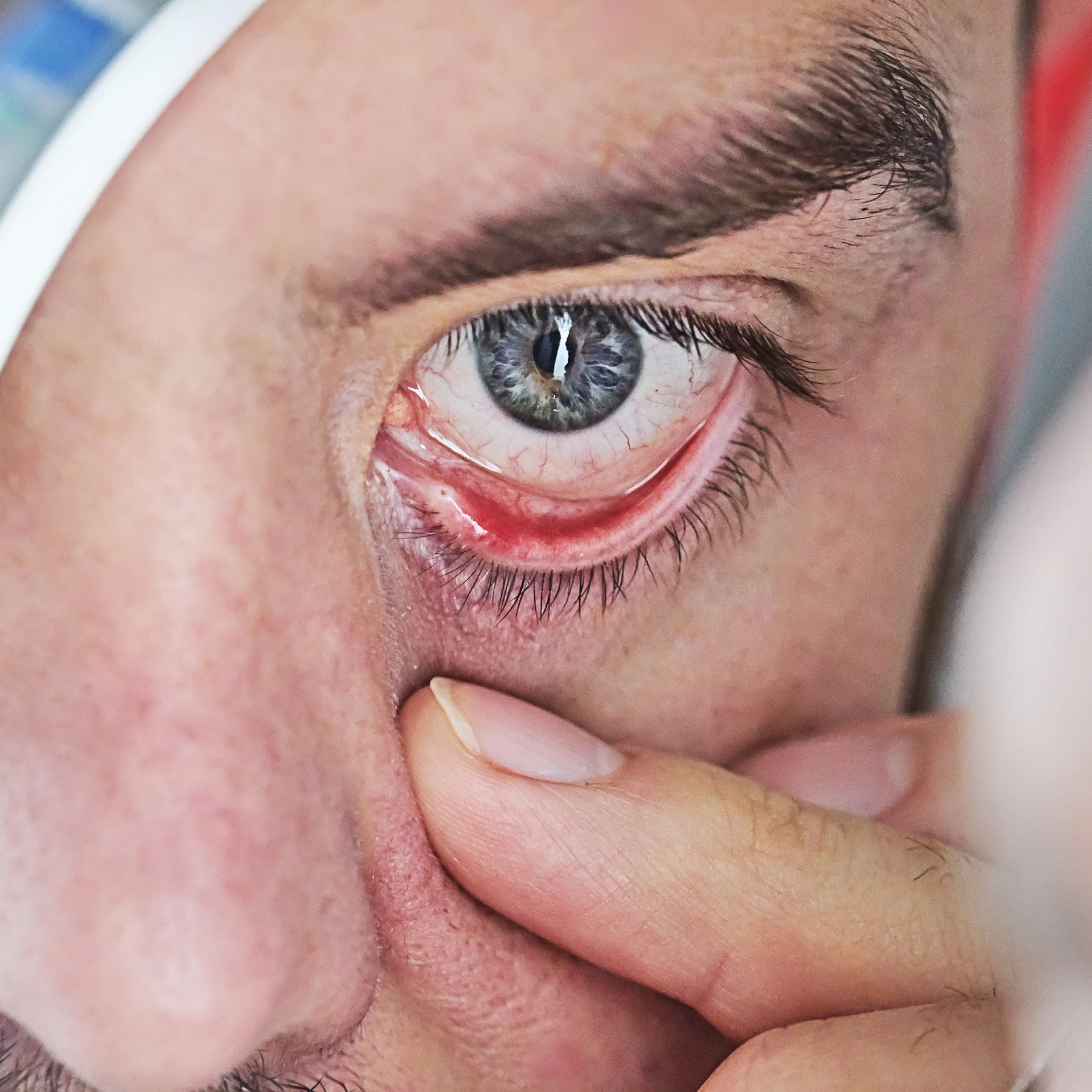 Dry Eye Managemen - Turakhia Opticians - Turakhia Opticians Goa | Panjim | Margao